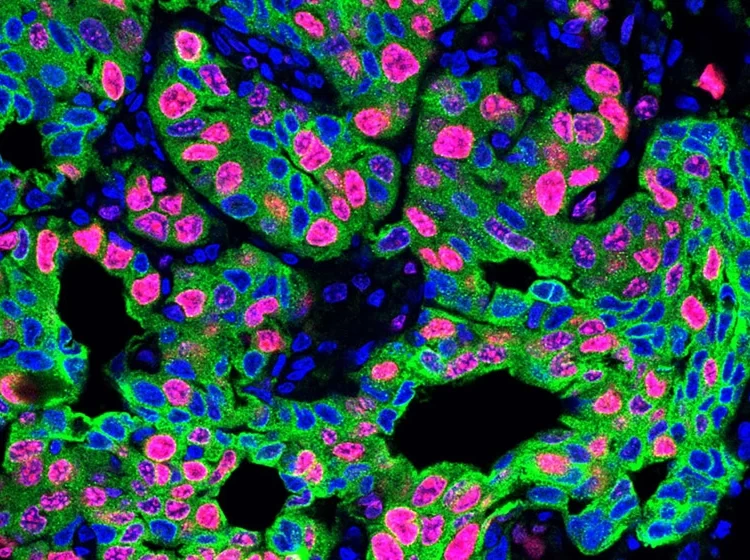 Warum chronischer Stress zu Krebs und Metastasen führt – Gestresste Immunzellen erleichtern die Krebsausbreitung